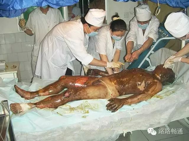 烫伤烧伤后中医如何处理
