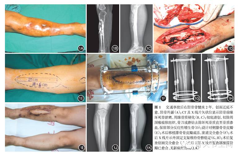 吻合血管的骨瓣移植治疗cierny-maderⅢ,Ⅳ型胫骨骨髓炎