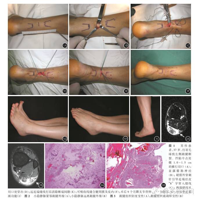 新型微创缝合技术治疗急性闭合性跟腱断裂