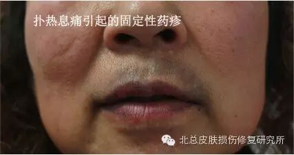 色素沉着 你真的伤不起 自由微信 Freewechat