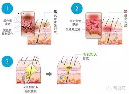 测测你的毛孔老化了吗?