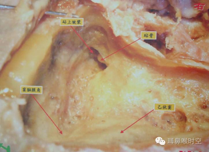 操作步骤详解乳突根治术