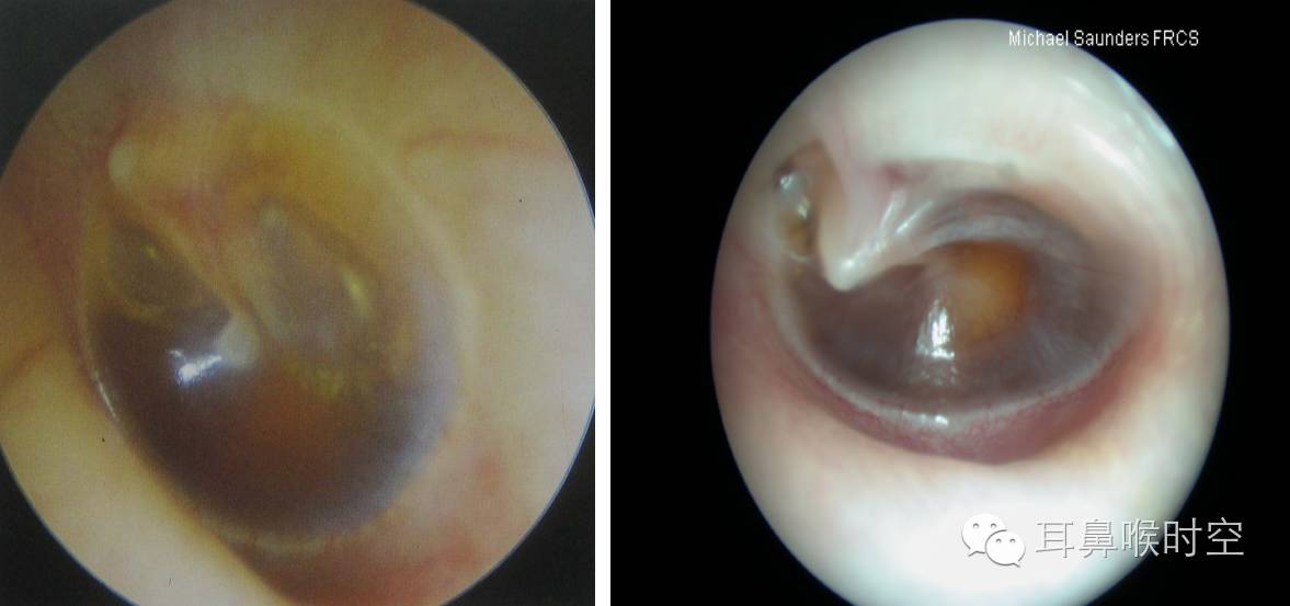分泌性中耳炎vs急,慢性中耳炎,细说中耳疾病的重点辨别