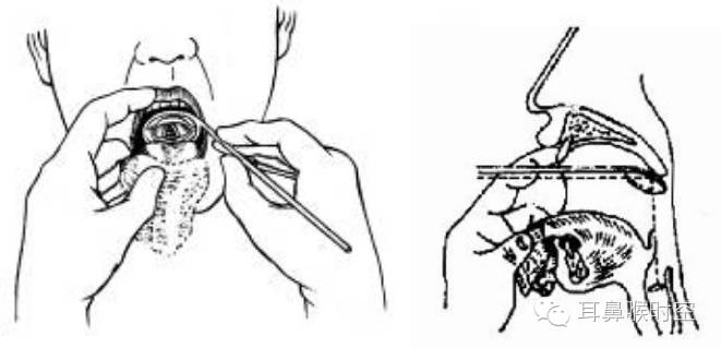 没有耳镜怎么使用耳鼻咽喉常见的检查方法，你值得拥有！_https://www.jmylbn.com_新闻资讯_第14张