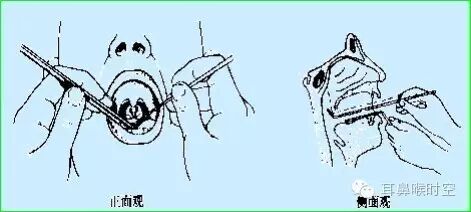 没有耳镜怎么使用耳鼻咽喉常见的检查方法，你值得拥有！_https://www.jmylbn.com_新闻资讯_第12张