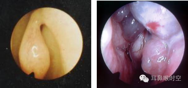 没有耳镜怎么使用耳鼻咽喉常见的检查方法，你值得拥有！_https://www.jmylbn.com_新闻资讯_第10张