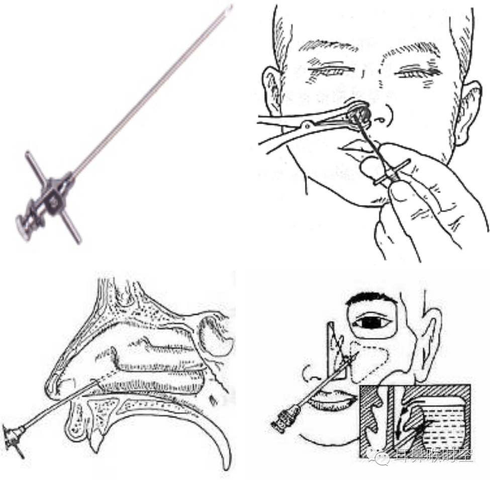 没有耳镜怎么使用耳鼻咽喉常见的检查方法，你值得拥有！_https://www.jmylbn.com_新闻资讯_第8张