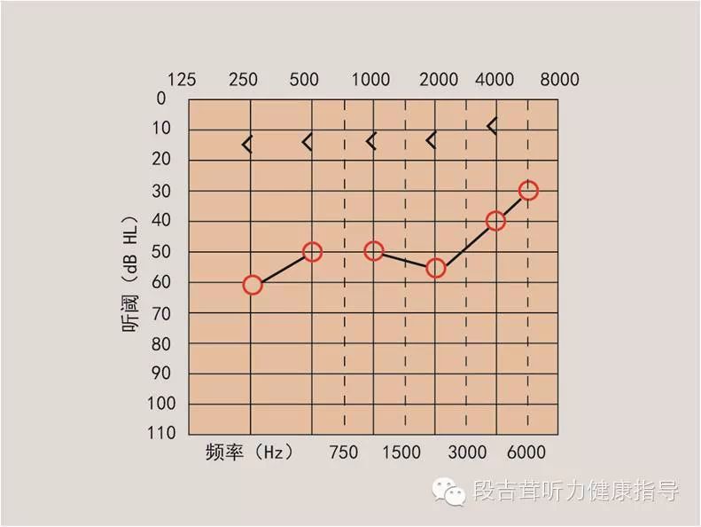 听力损失的类型包括: 1. 传导性(外耳或中耳出问题)