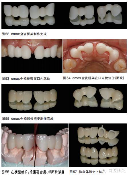 上前牙全瓷固定桥美学修复一例