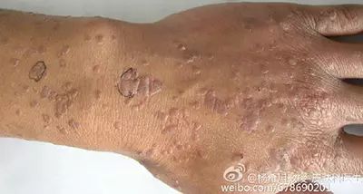 关于扁平疣,你应该知道! 转载自杨希川教授