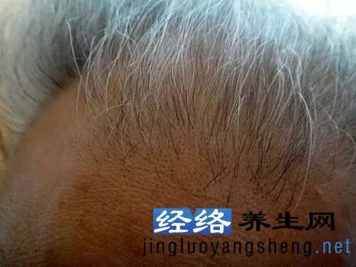 家人拍打生发乌发的故事