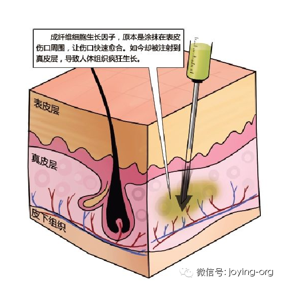 不能注射"生长因子"