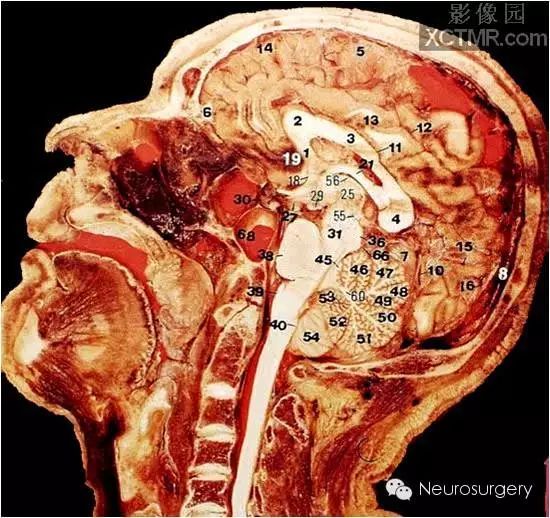 1,丘脑 2,内囊后肢 3,豆状核4,尾状核 5,侧脑室 6,额内侧回7,扣带回