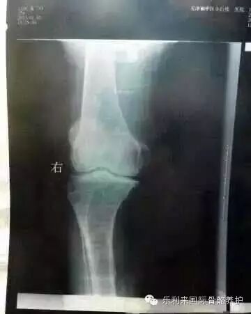 滑膜炎”是怎么回事