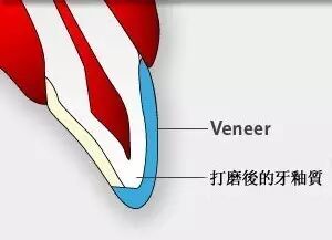 牙齿美容的新宠--超薄美白瓷贴面