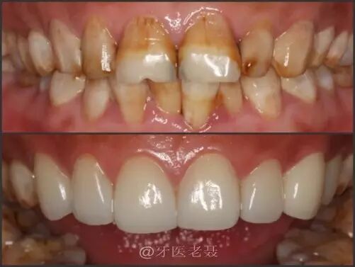 牙齿美容的新宠--超薄美白瓷贴面