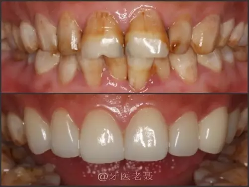 牙齿美容的新宠--超薄美白瓷贴面 牙齿美容的新宠--超薄美白瓷贴面