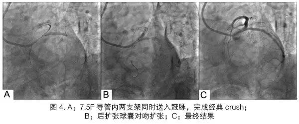 桡动脉鞘怎么读陈晖：经桡动脉无鞘指引导管的应用经验介绍——7.5F Sheathless Eaucath导引导管使用经验_https://www.jmylbn.com_新闻资讯_第4张