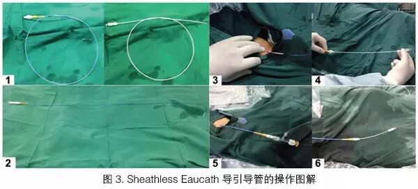 桡动脉鞘怎么读陈晖：经桡动脉无鞘指引导管的应用经验介绍——7.5F Sheathless Eaucath导引导管使用经验_https://www.jmylbn.com_新闻资讯_第3张