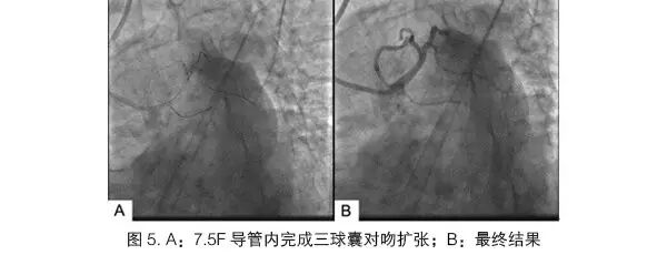 桡动脉鞘怎么读陈晖：经桡动脉无鞘指引导管的应用经验介绍——7.5F Sheathless Eaucath导引导管使用经验_https://www.jmylbn.com_新闻资讯_第5张