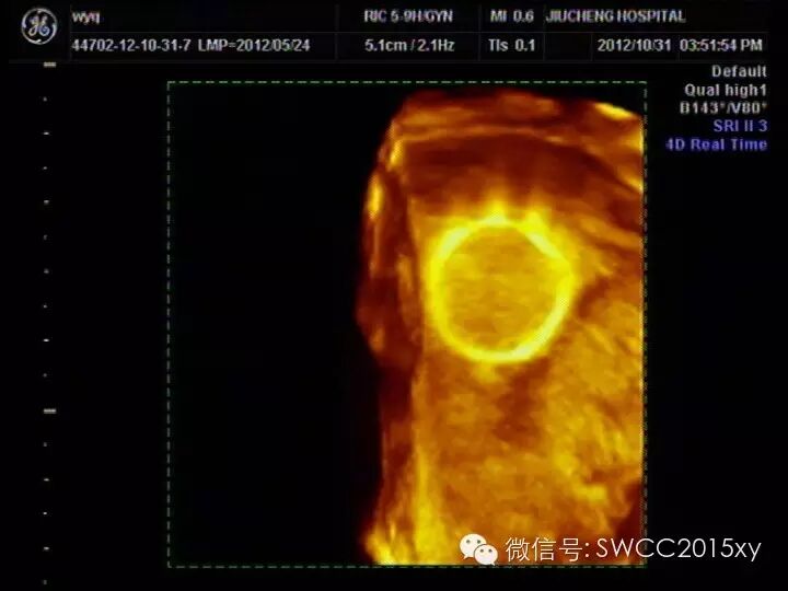 宫内有节育器咋还会怀孕,对胎儿有影响吗?-怀孕期