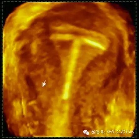宫内有节育器咋还会怀孕,对胎儿有影响吗?-怀孕期