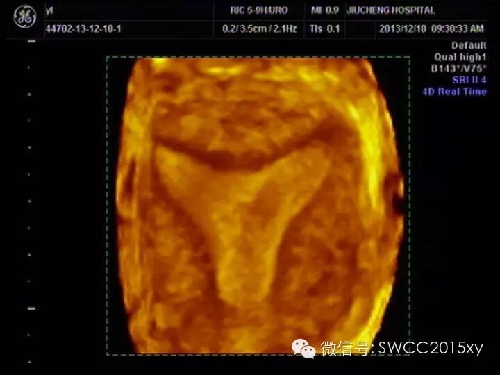 宫内有节育器咋还会怀孕,对胎儿有影响吗?-怀孕期