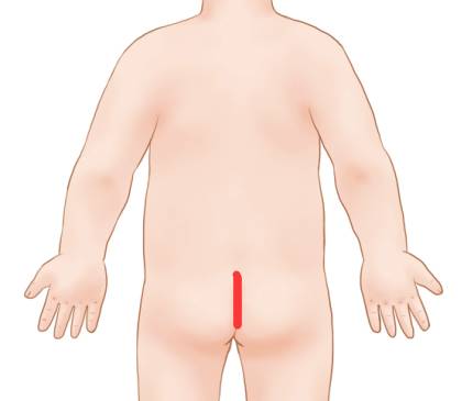 长强定位:位于尾骨端下,尾骨端与肛门连线的中点处.