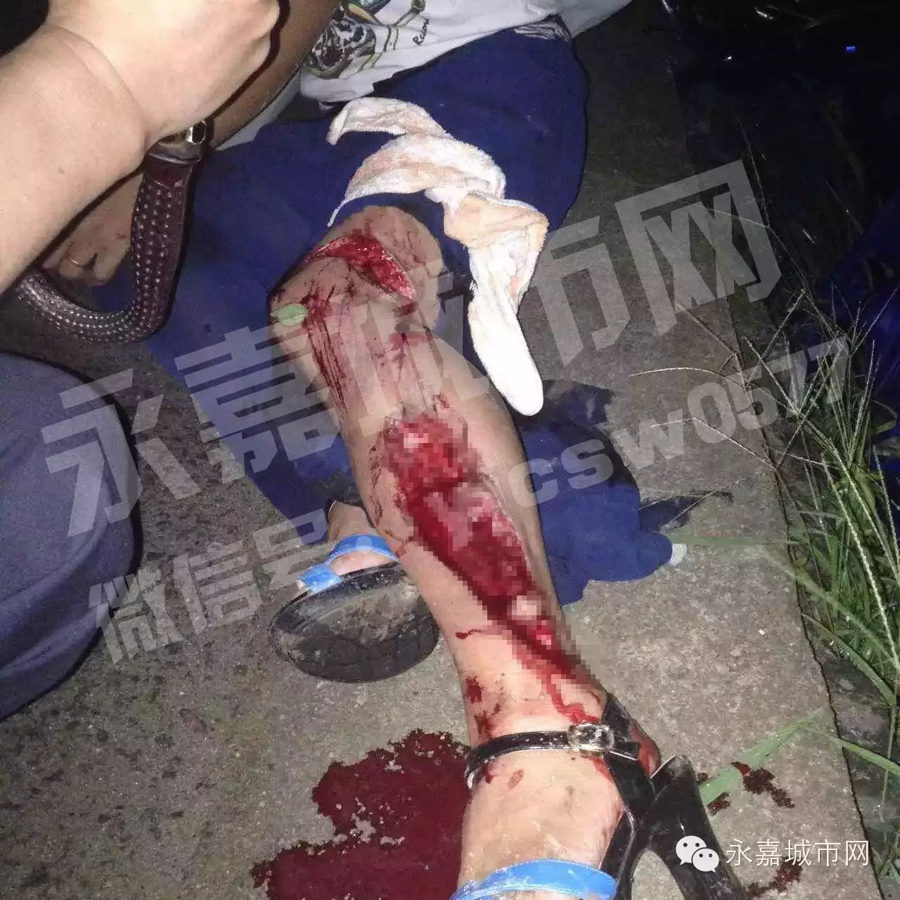 永嘉一情侣吵架,女的生生少了一块肉(图片血腥,慎入)