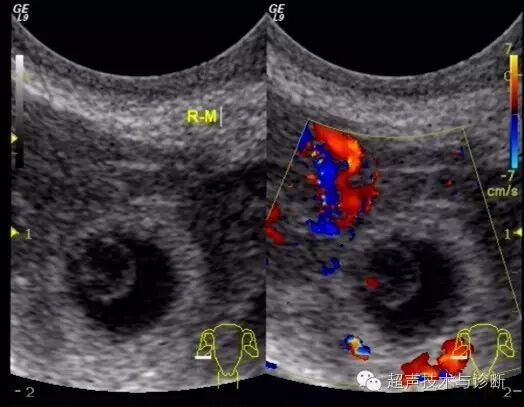 【病例讨论】宫内、宫外一起怀孕?-怀孕期