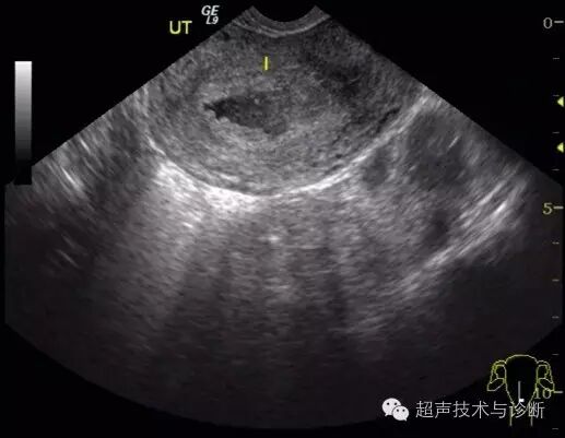 【病例讨论】宫内、宫外一起怀孕?-怀孕期