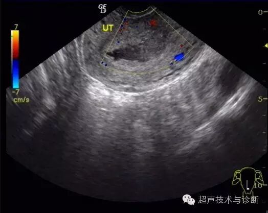 【病例讨论】宫内、宫外一起怀孕?-怀孕期