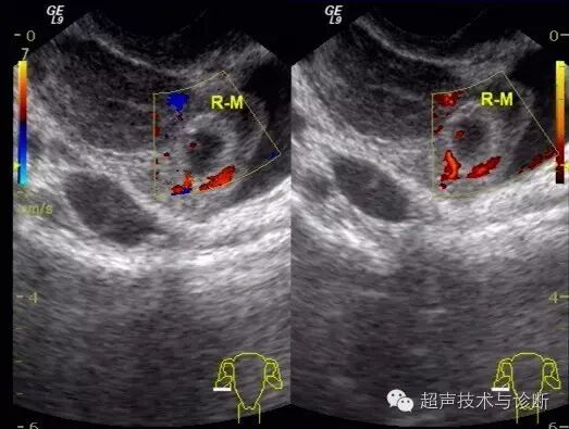 【病例讨论】宫内、宫外一起怀孕?-怀孕期