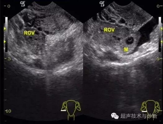 【病例讨论】宫内、宫外一起怀孕?-怀孕期