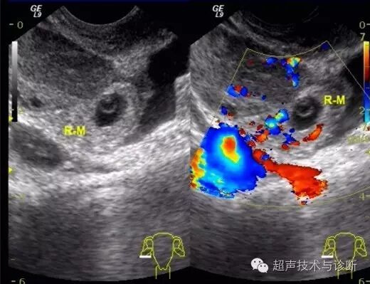 【病例讨论】宫内、宫外一起怀孕?-怀孕期