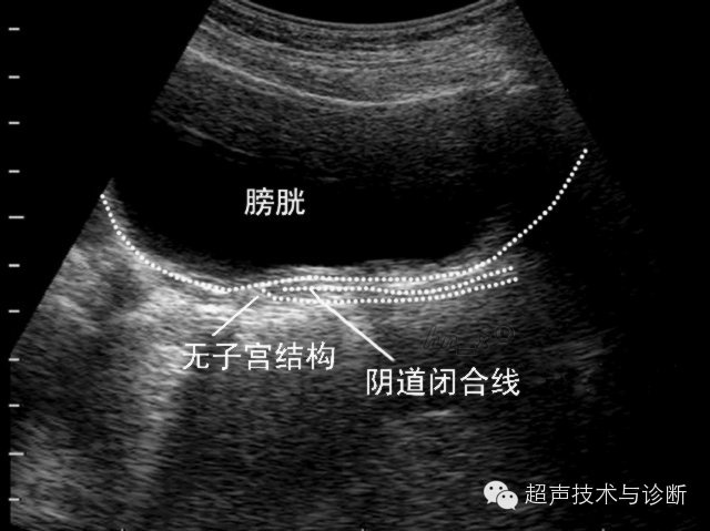 先天性无子宫:任何切面均未显示子宫,此类畸形常合并先天性无阴道.