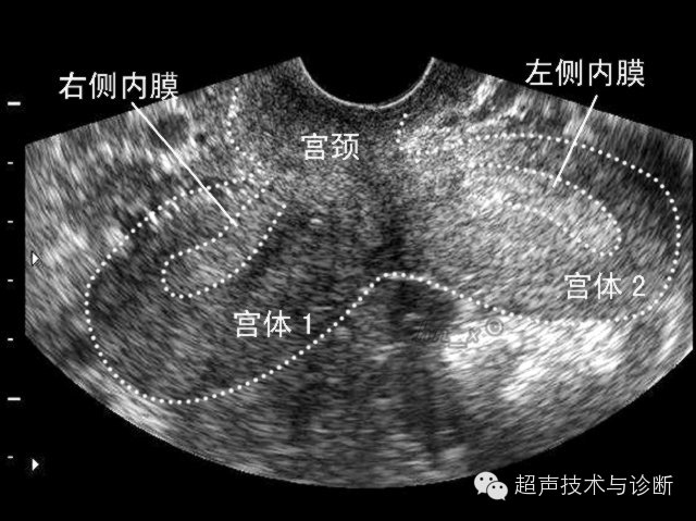 [腹盆] 每日讲解之妇科(一):先天性子宫畸形的b超表
