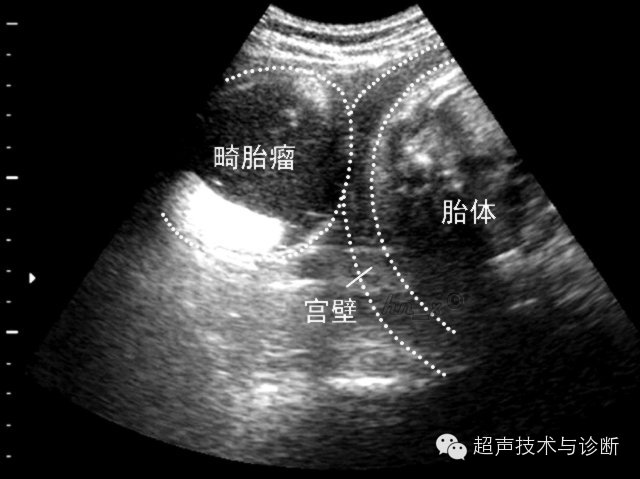 69 超声医学版 69 【每日讲解】之妇科(十二):卵巢畸胎瘤