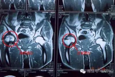 股骨头坏死还可以这么治