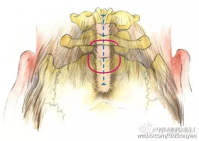 中线切口应下达c2棘突(该解剖结构较易触及)