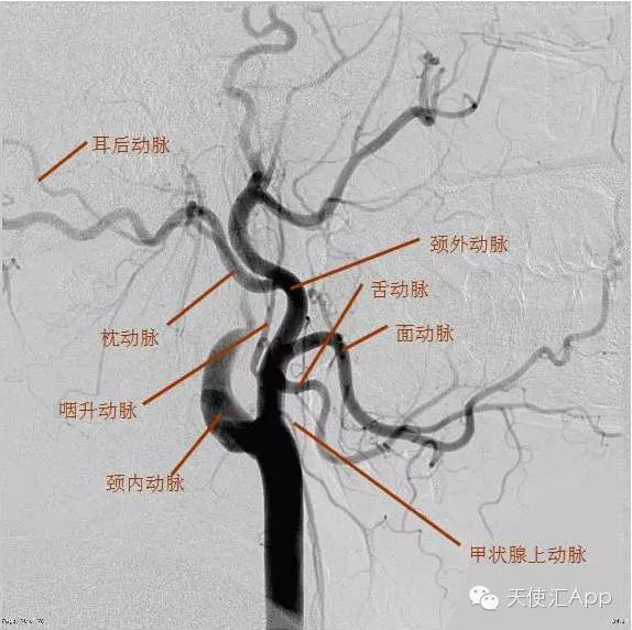 图5 颈外动脉解剖示意图 (四)颈内动脉 颈内动脉自颈总动脉发出后,在