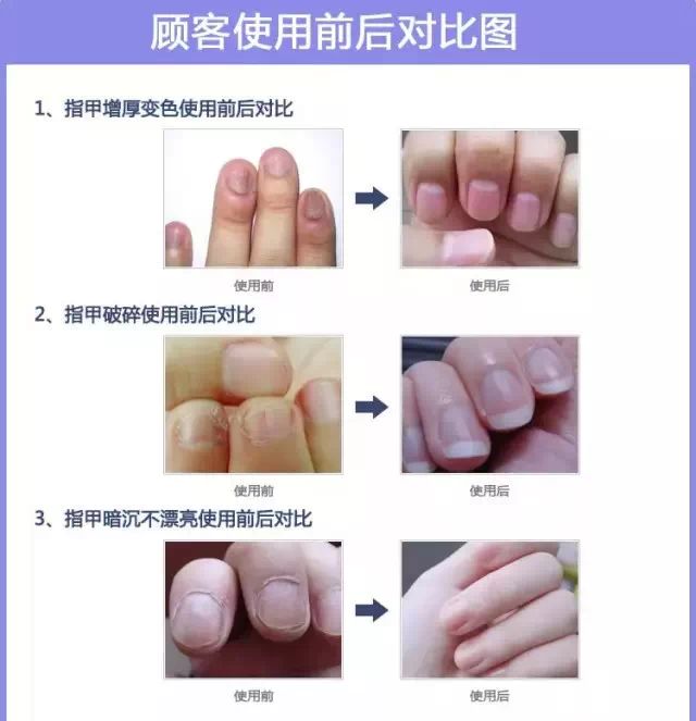 美甲亮甲首先杜绝和治疗灰指甲—草本活力再生复甲液~手脚通用-