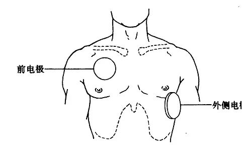 并稍用力以便电能量从除颤器到达心脏,而在电极与皮肤的界面上没有