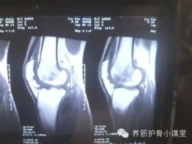 “滑膜炎”是怎么回事？