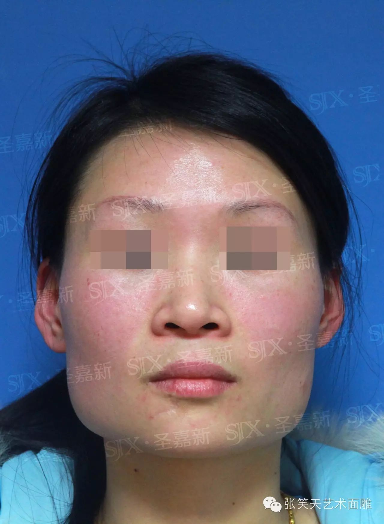 如何正确辨别下颌角与咬肌肥大