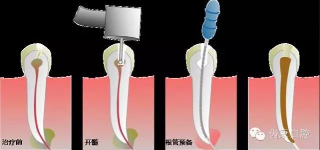 一目了然让你了解"根管治疗"