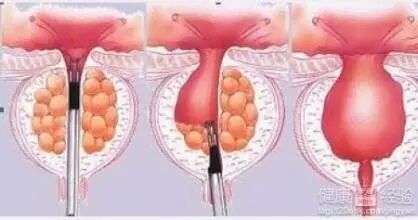 前列腺囊肿有没有危险?