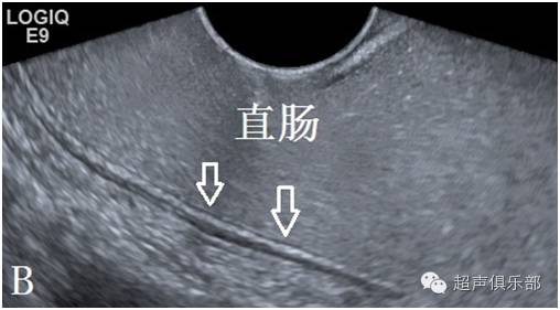 胃肠超声专栏[9]大肠标准超声切面及正常声像图(上)