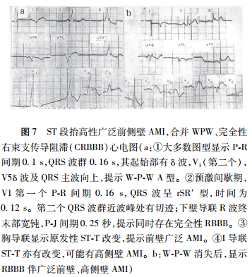 急性心脏事件体表心电图预警急性心肌缺血事件