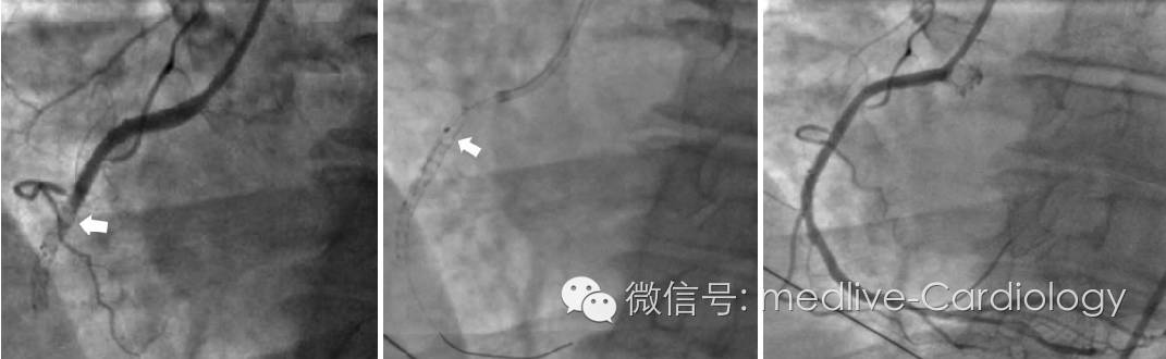 图23 外科手术前1天因下壁stemi行急诊冠状动脉造影显示rca中段st